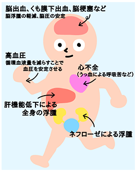 利尿薬が使用されている疾患まとめ