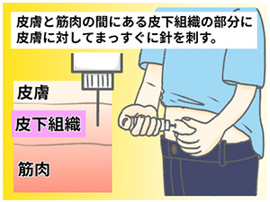 インスリン注射方法イメージ